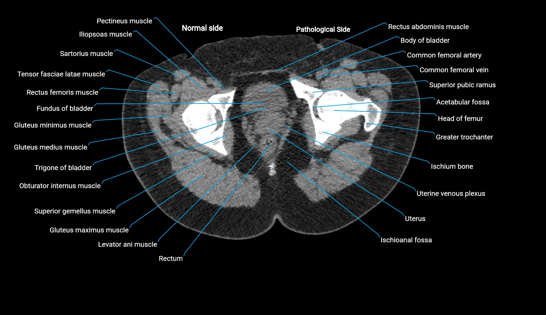 CT KUB axial cross sectional anatomy  radiology image -img-00201-00163.webp